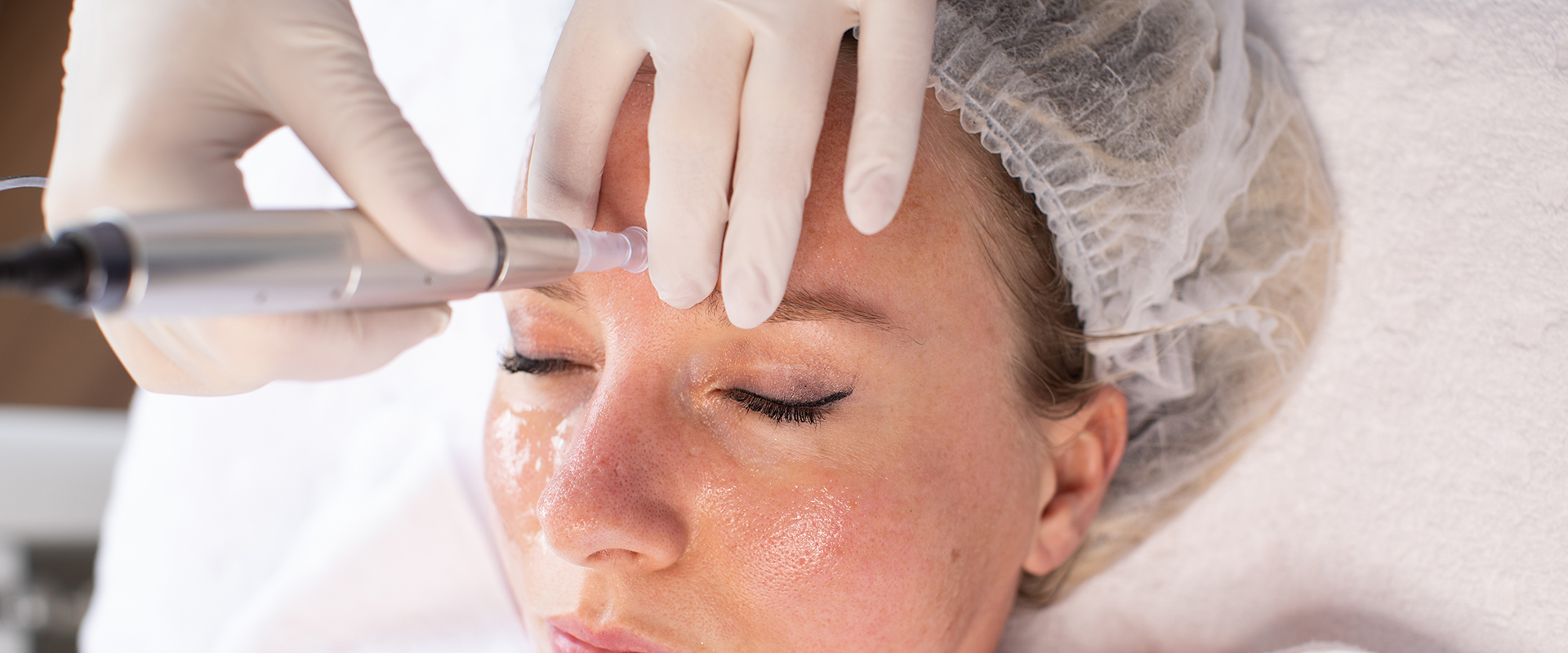 Microneedling - N.M. Beauty Lounge